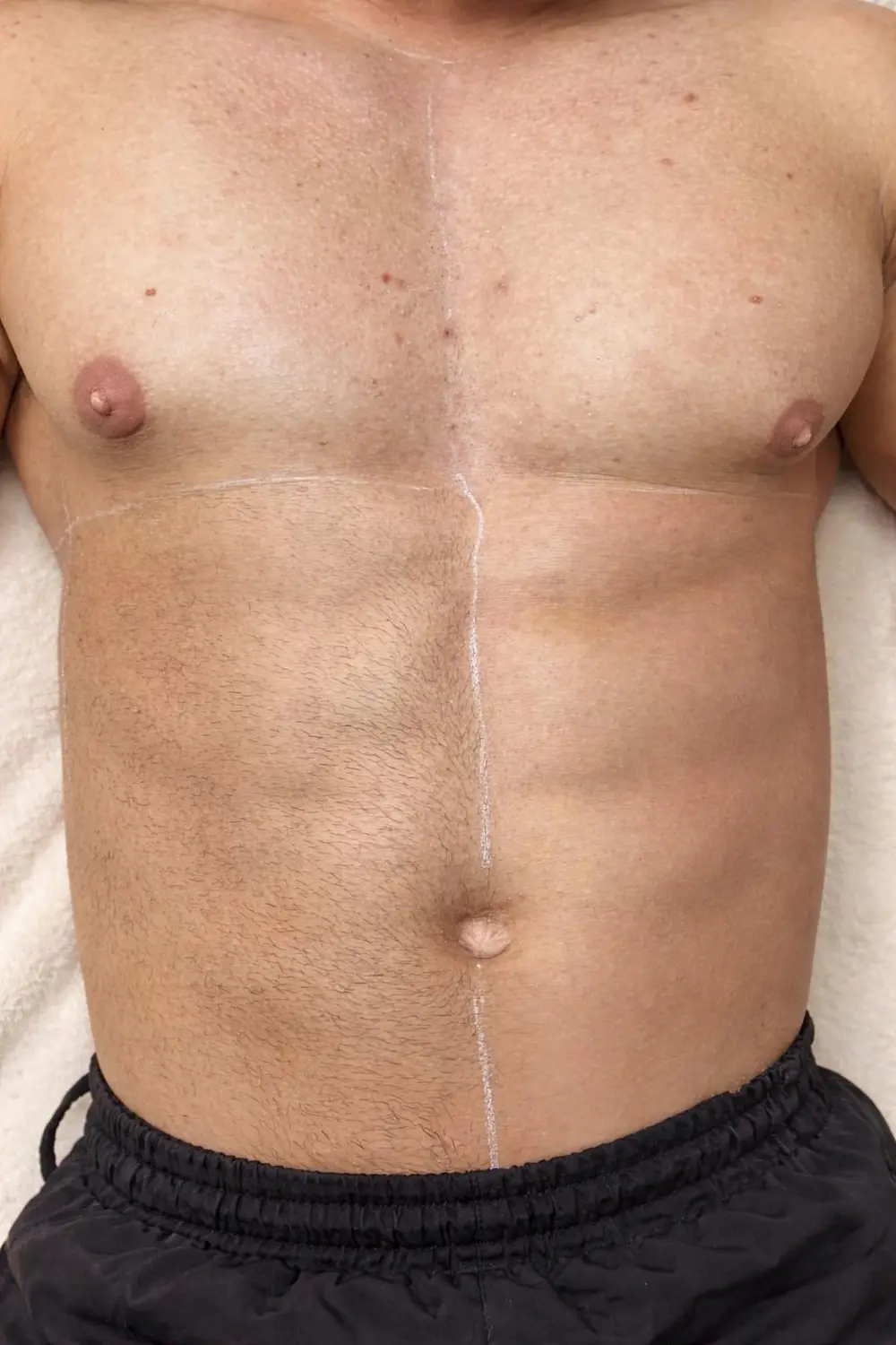 Men's chest laser hair removal before and after at ELIIXA