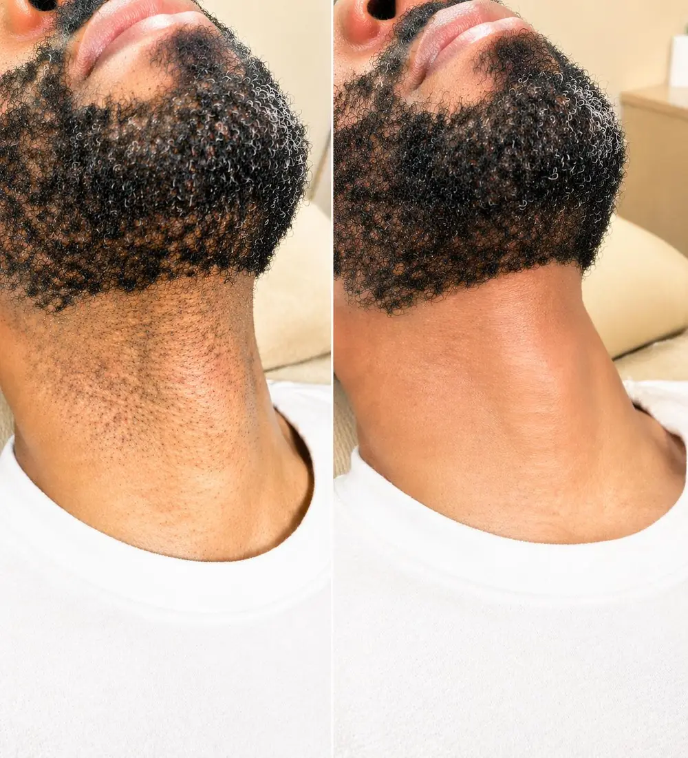 Neck and beard-line laser hair removal before and after at ELIIXA