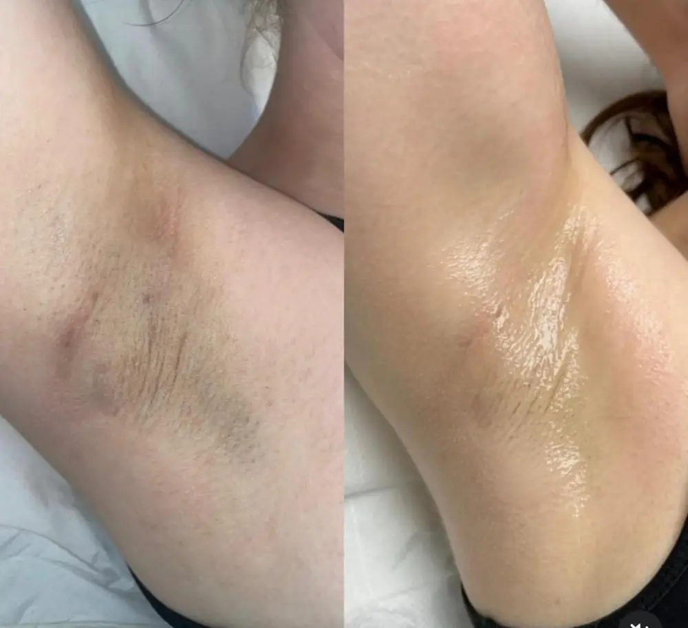Underarm laser hair removal before and after at ELIIXA