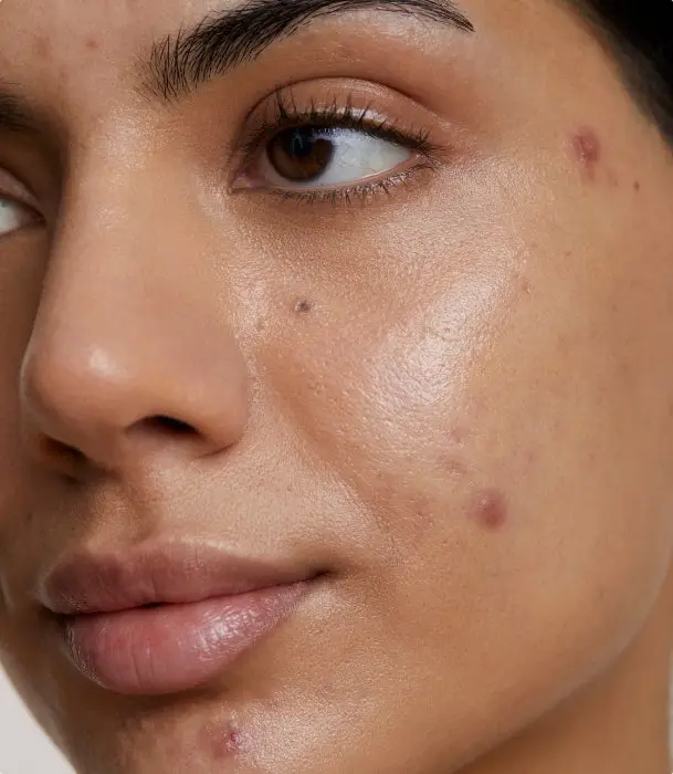 Close-up of skin affected by acne & acne scarring