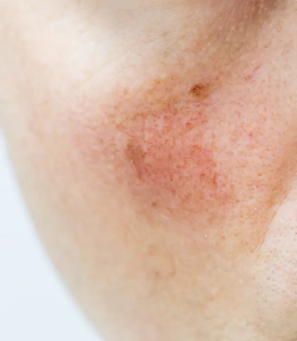 Close-up of skin affected by broken capillaries and spider veins