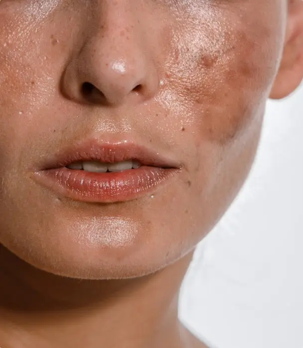 Close-up of skin affected by melasma