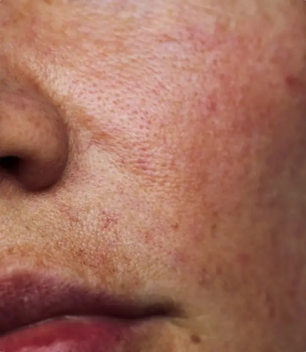 Close-up of skin affected by rosacea / redness