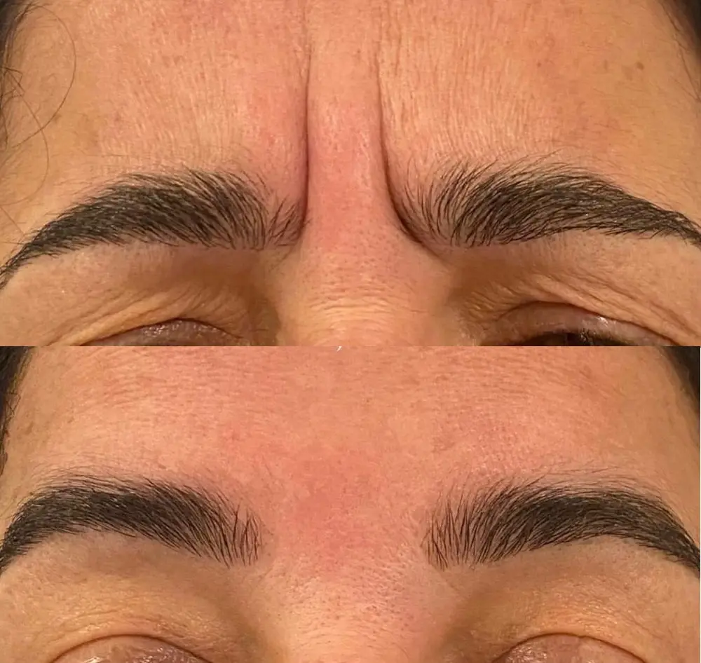 Anti Wrinkle at ELIIXA