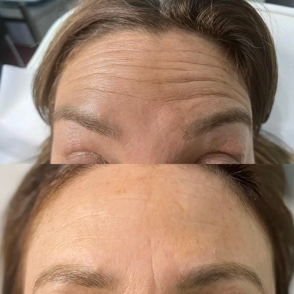 Anti Wrinkle at ELIIXA