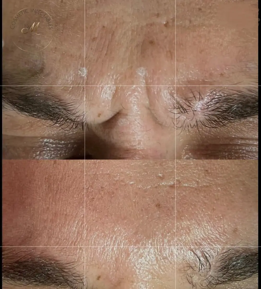 Anti Wrinkle at ELIIXA