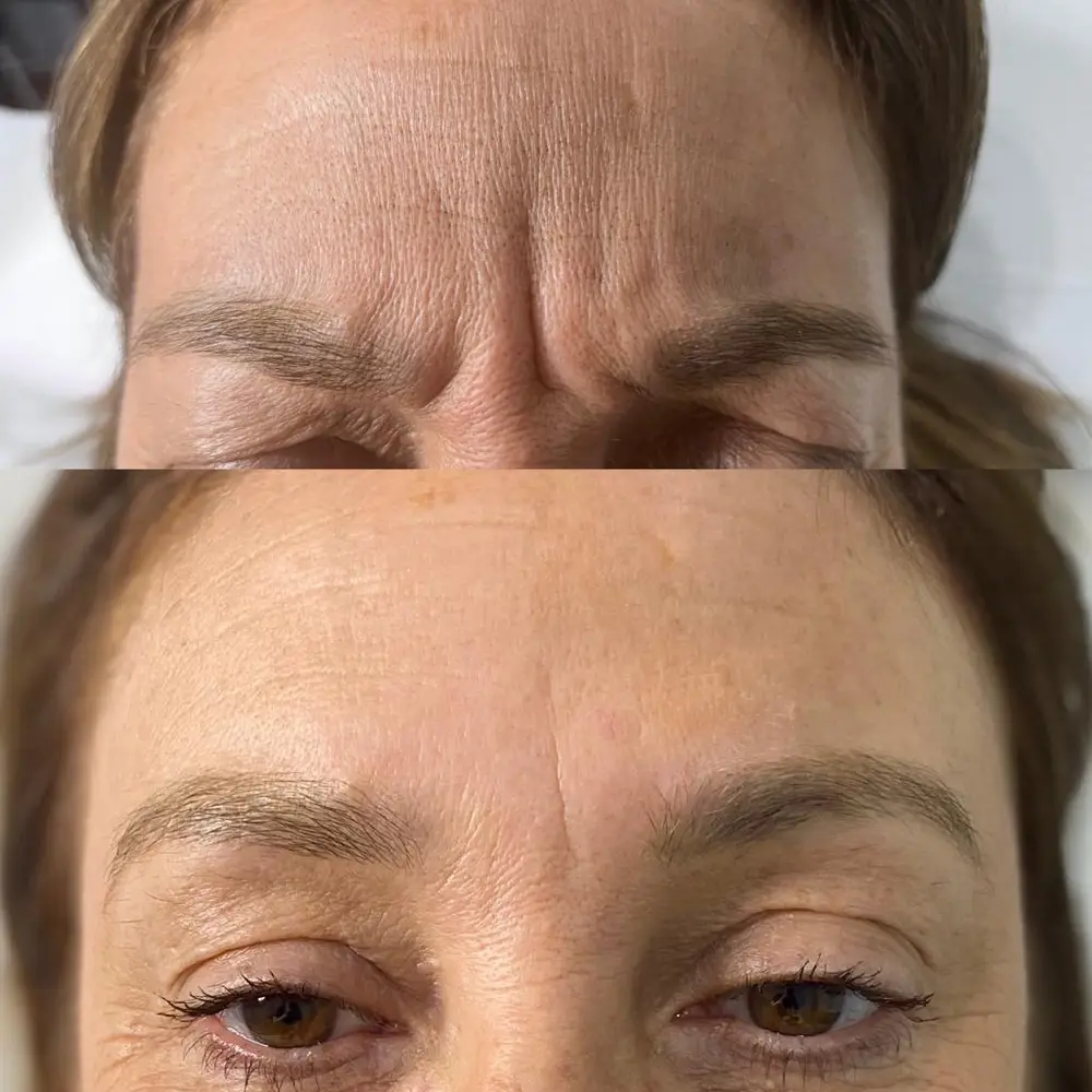 Anti Wrinkle at ELIIXA