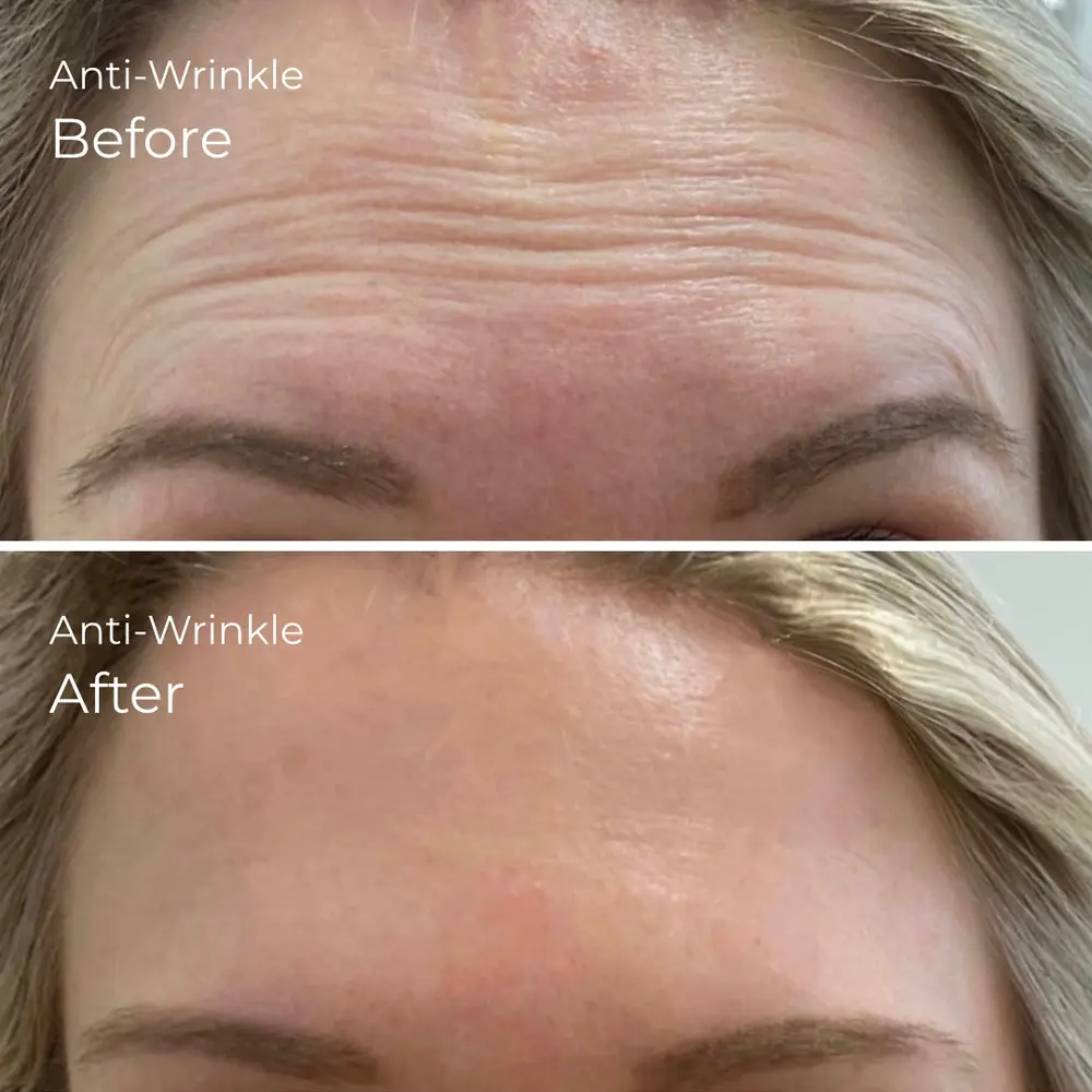 Anti Wrinkle at ELIIXA