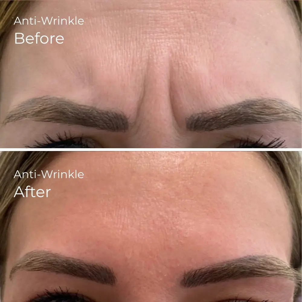 Anti Wrinkle at ELIIXA
