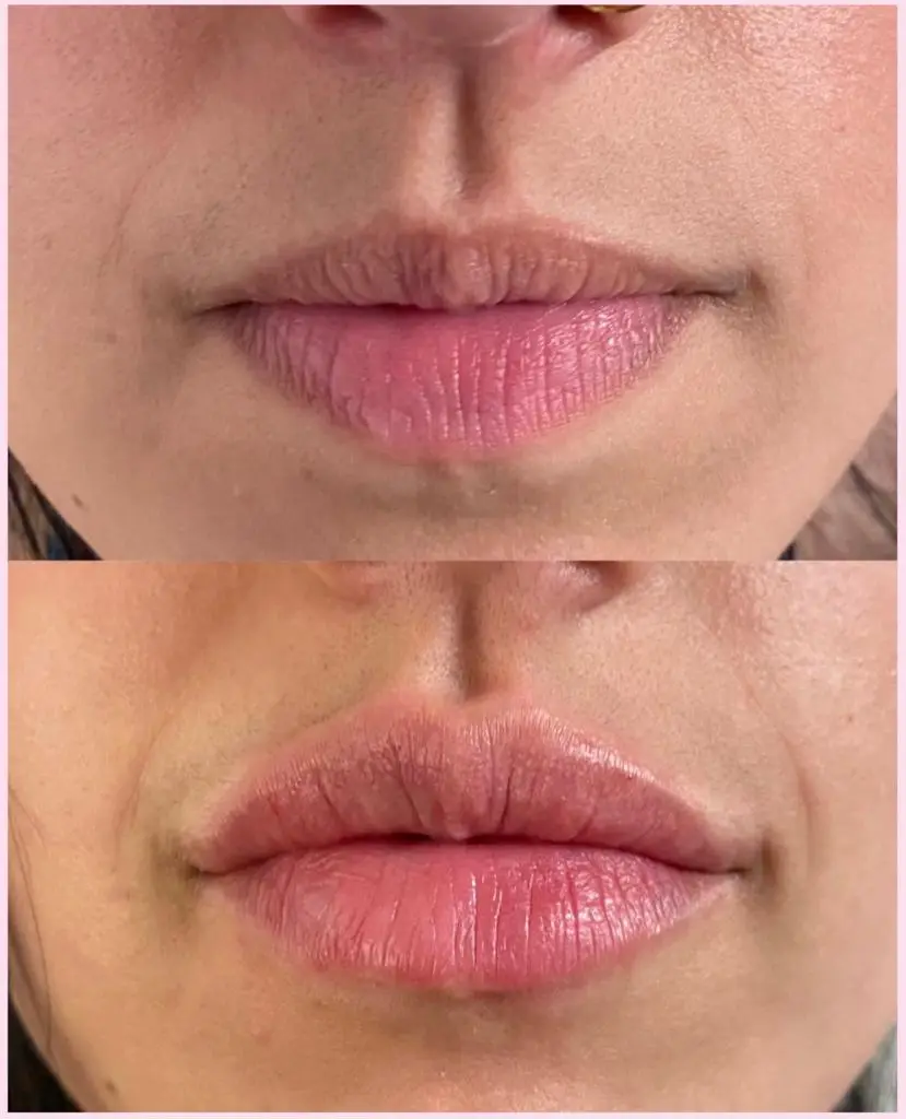 Dermal Filler at ELIIXA
