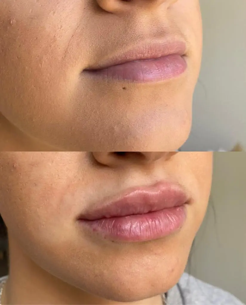 Dermal Filler at ELIIXA