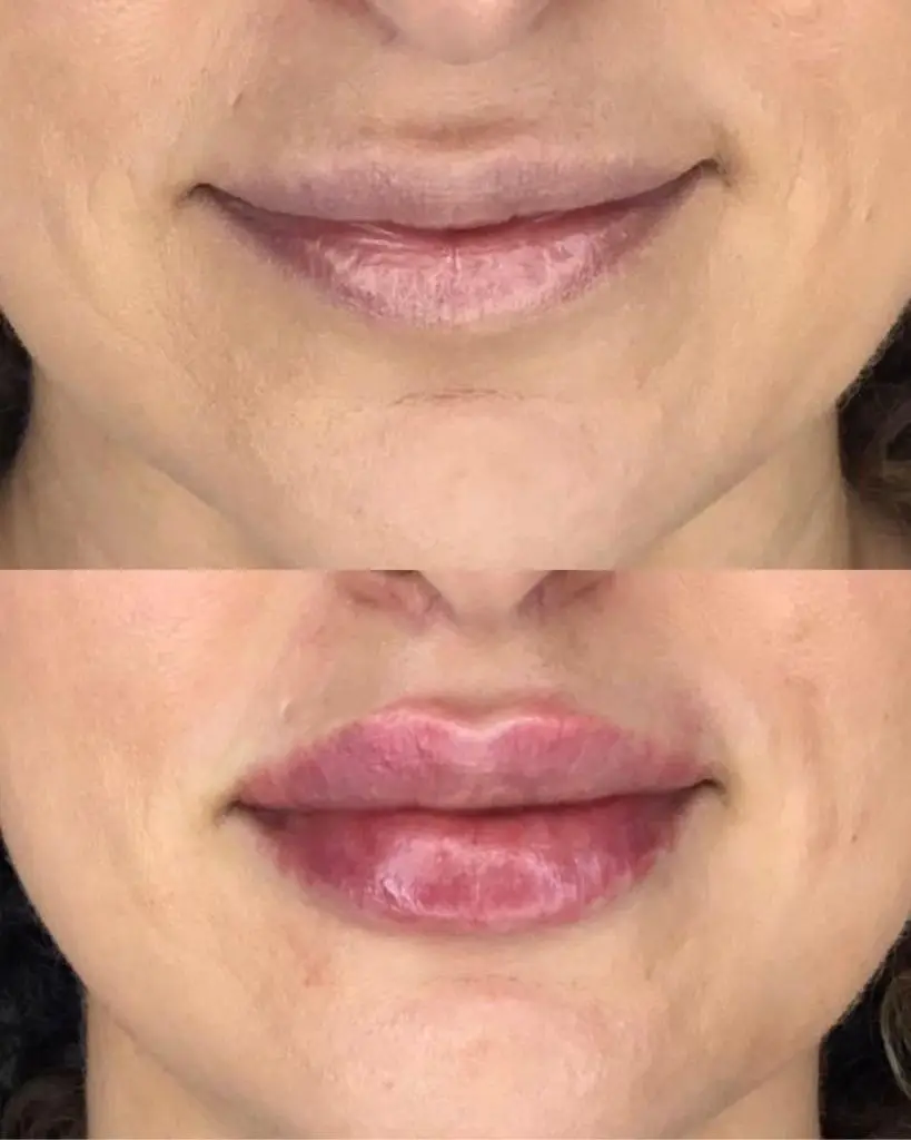 Dermal Filler at ELIIXA