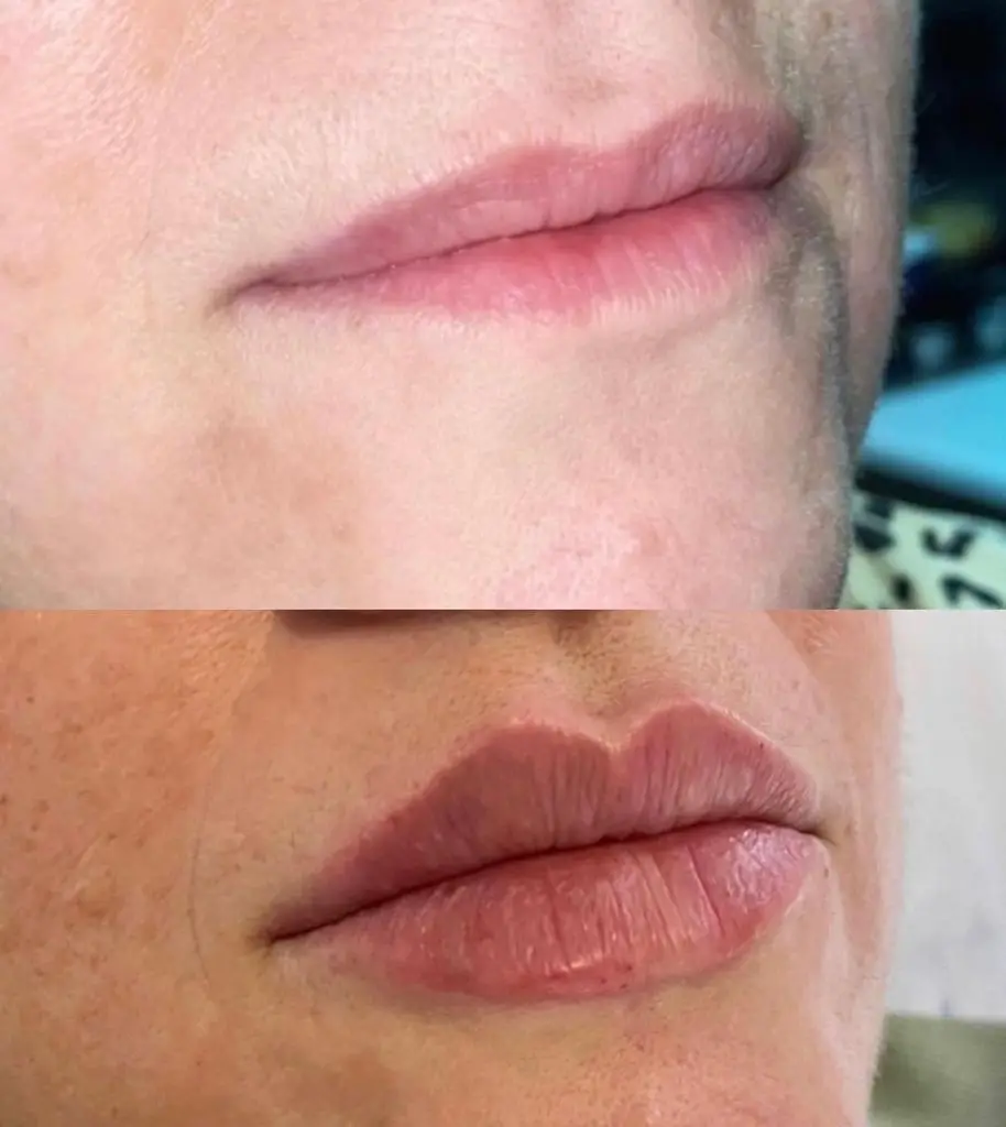 Dermal Filler at ELIIXA