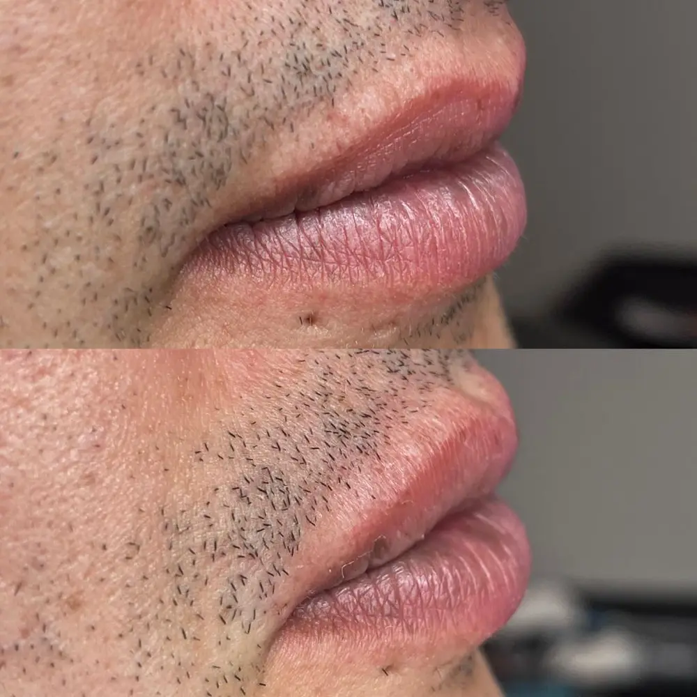 Dermal Filler at ELIIXA