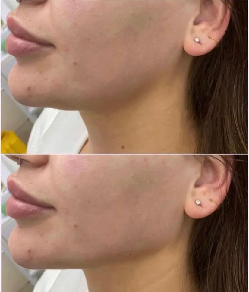 Dermal Filler at ELIIXA