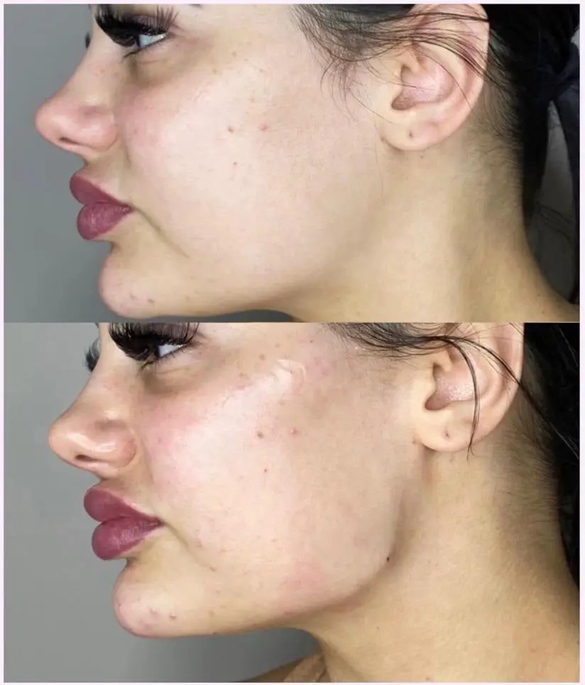 Dermal Filler at ELIIXA