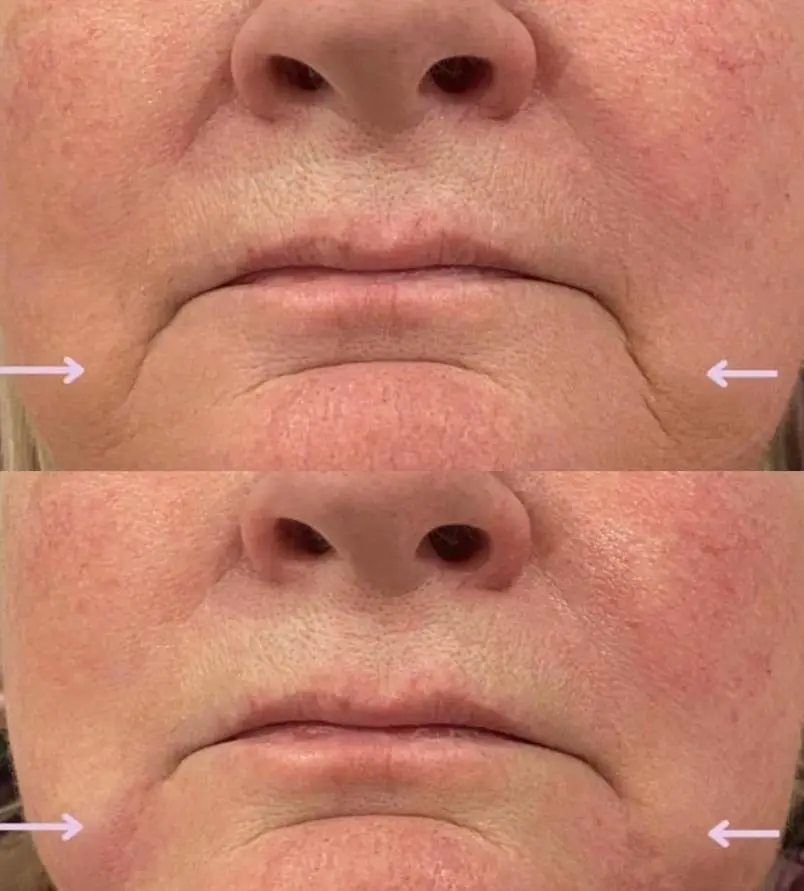 Dermal Filler at ELIIXA