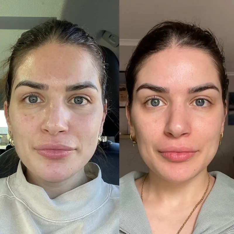 V2 Skin Booster at ELIIXA