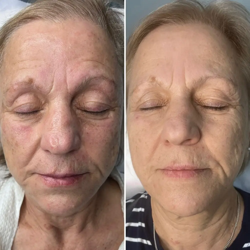 V2 Skin Booster at ELIIXA