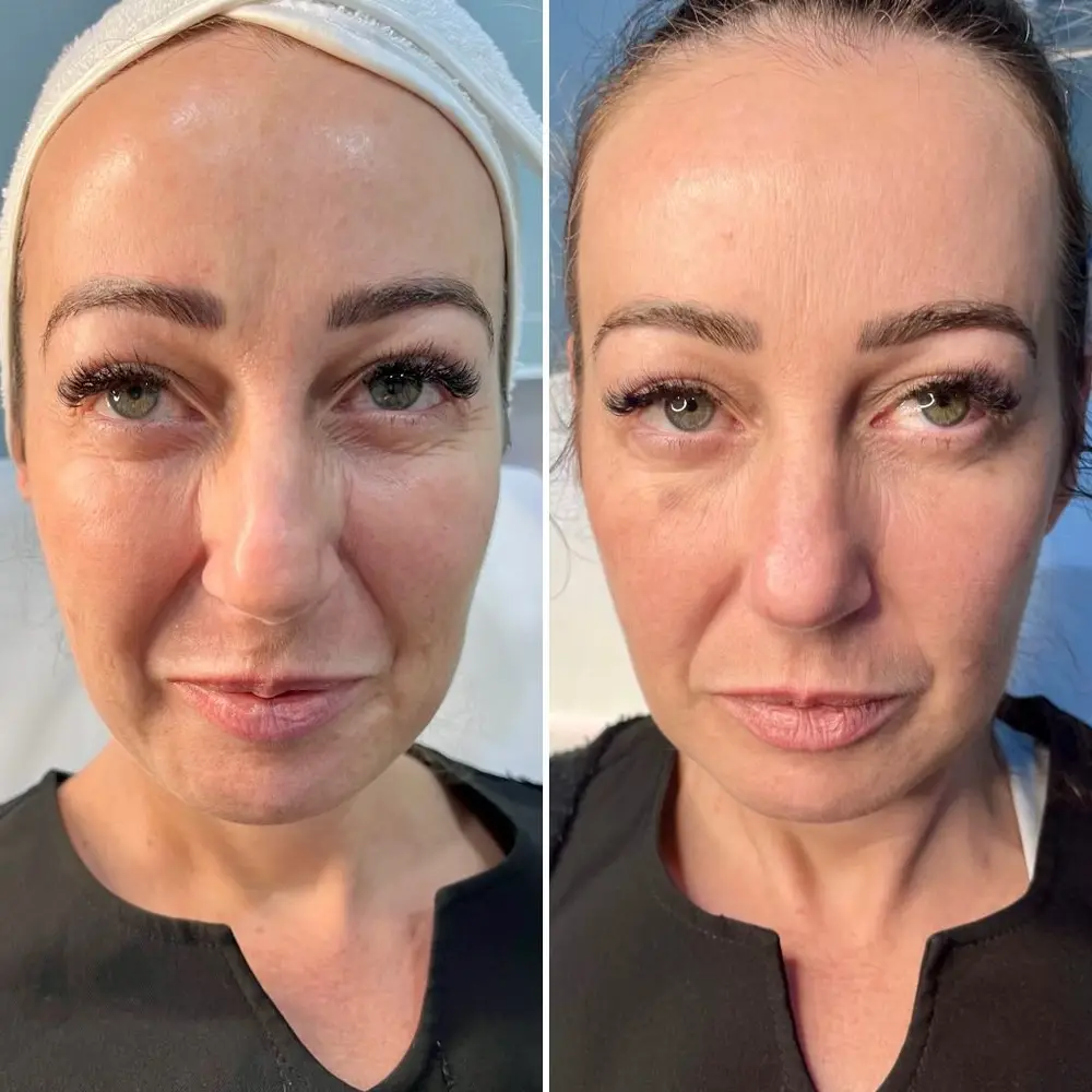 V2 Skin Booster treatment at ELIIXA