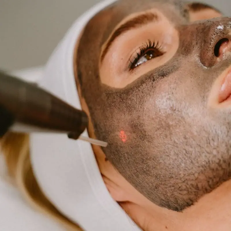 Carbon Laser Peel at ELIIXA