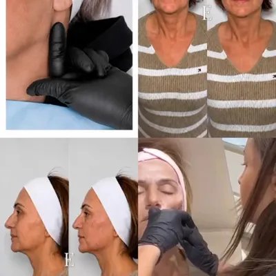 Lifting threads are more than just a lifting treatment; they’re also a powerful collagen stimulating procedure.