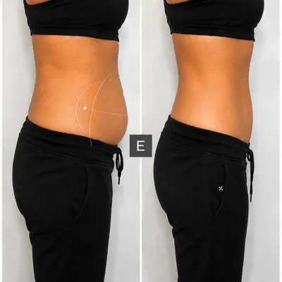 Body Contouring and Targeted Areas