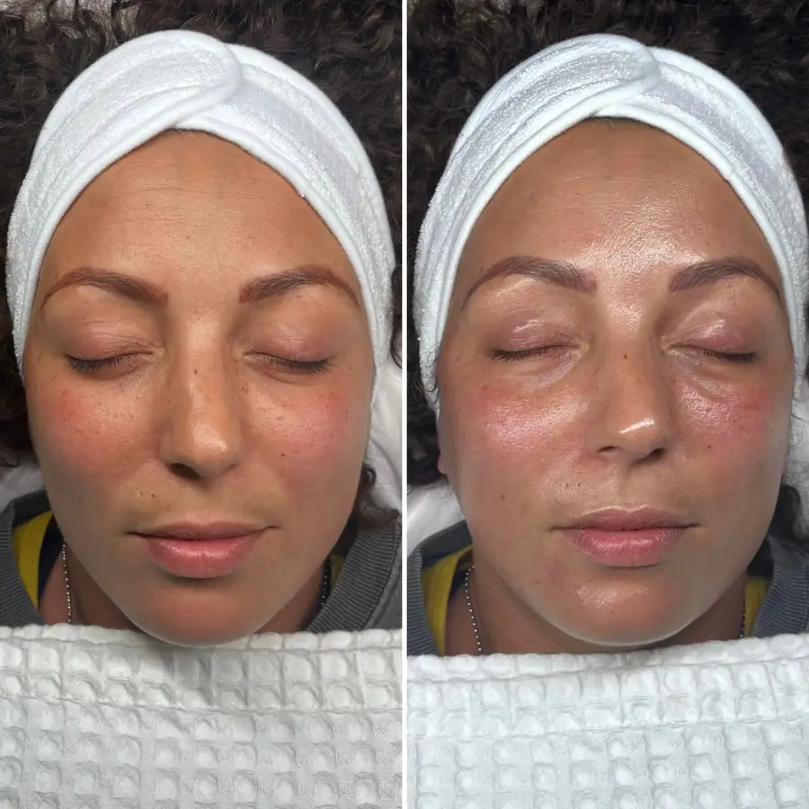 HydraFacial Hydrate, Glow, Fire & Ice at ELIIXA
