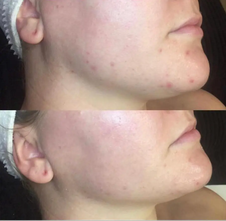 Microdermabrasion at ELIIXA
