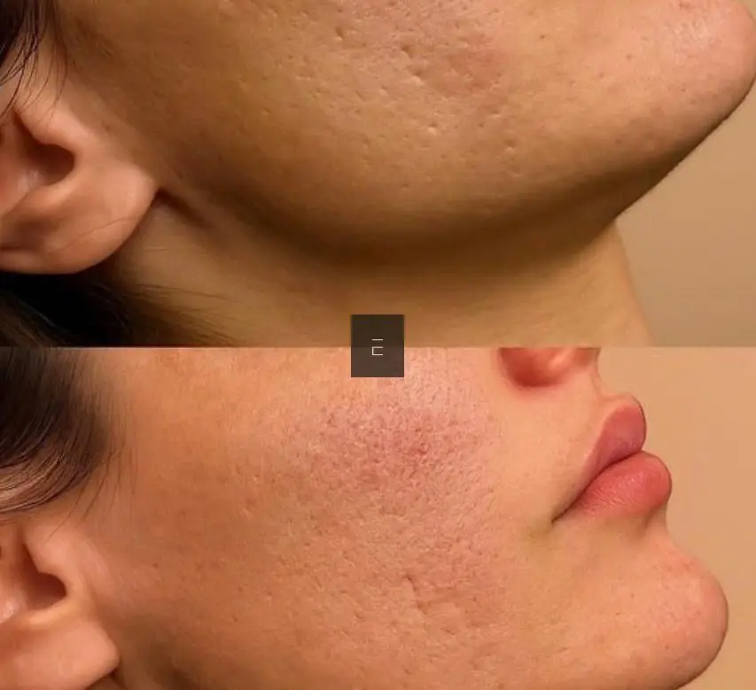 Secret RF Skin Needling at ELIIXA